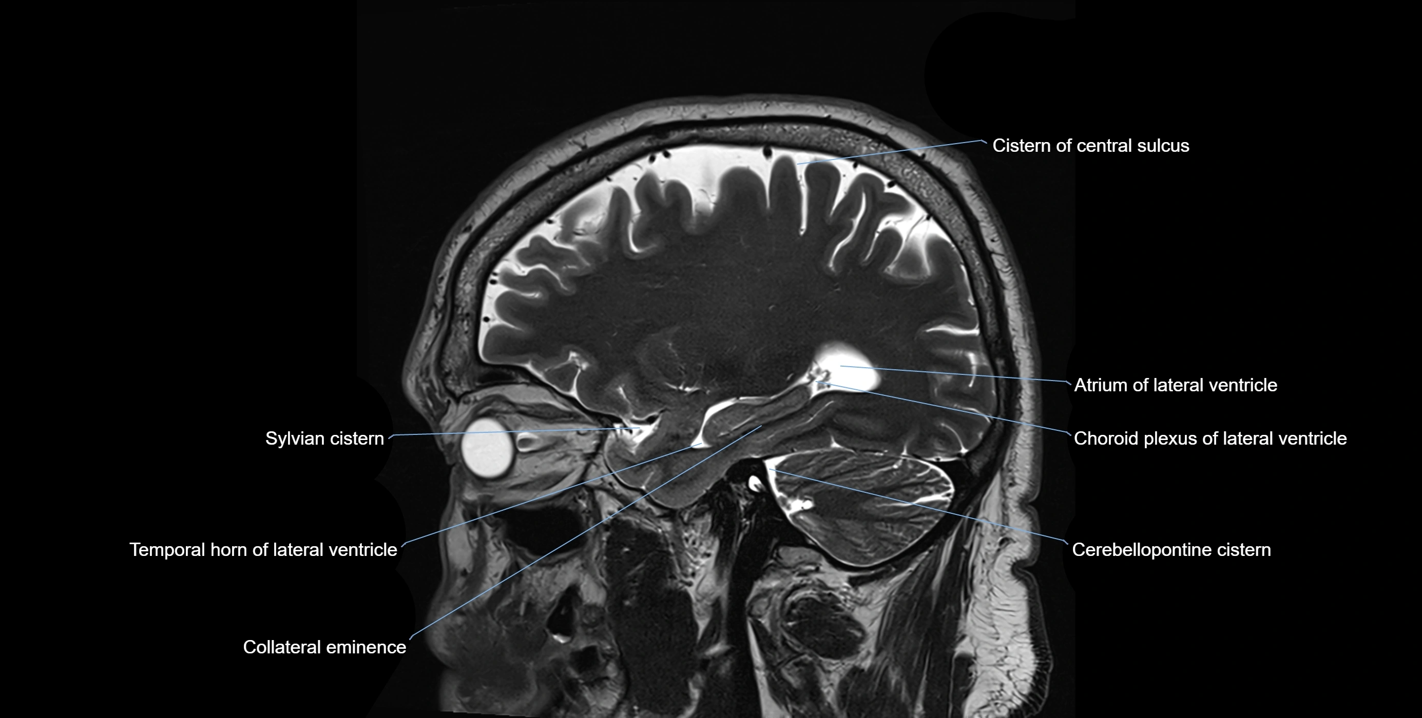Brain cisterns  and ventricles sagittal anatomy 3T MRI image-img-00001-00016.webp